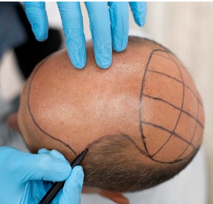 Dermapen Saçlı Deri Uygulaması